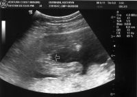 Ultrasound_081017_01