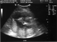 Ultrasound_081017_02