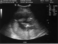 Ultrasound_081017_03