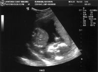 Ultrasound_081017_04