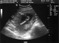 Ultrasound_081017_05