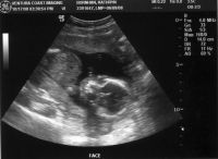 Ultrasound_081017_07