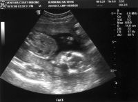 Ultrasound_081017_08