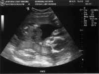 Ultrasound_081017_09