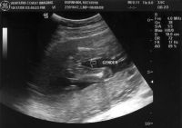 Ultrasound_081017_11